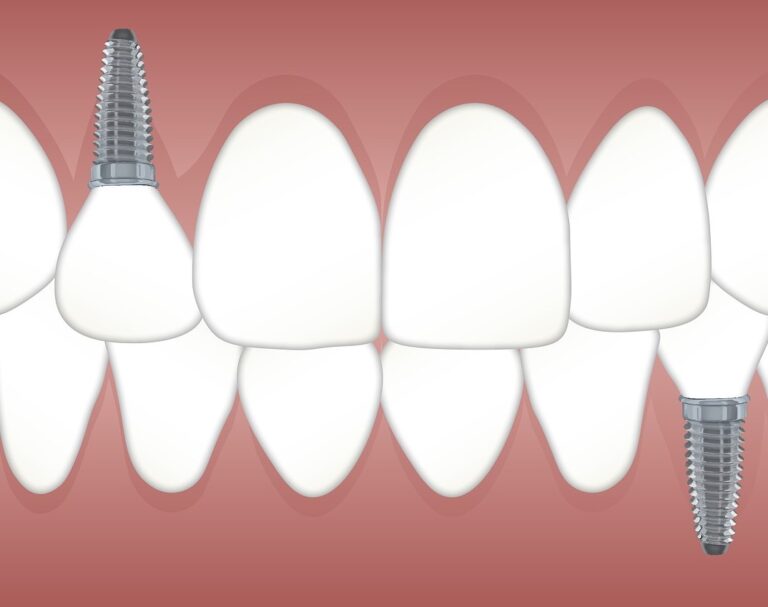 Orthodontic Implants